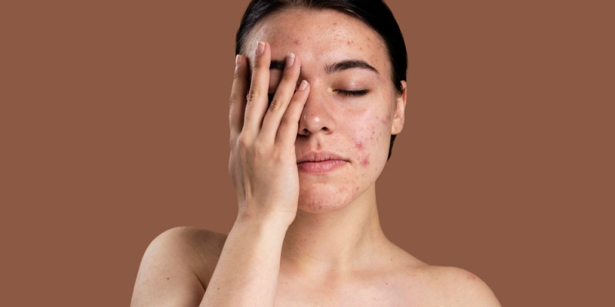 Homeopathy vs Allopathy: Which is better for treating pimples? Find out here!