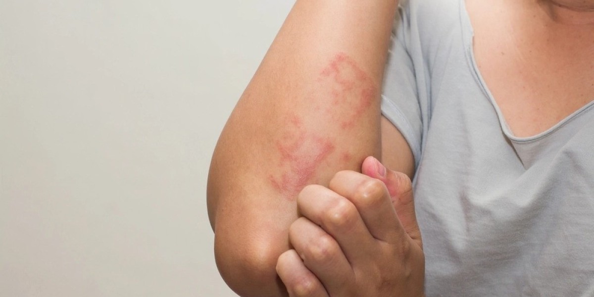 Combat Scabies with Ivermectin 12mg: Safe and Effective Therapy - Meds4go